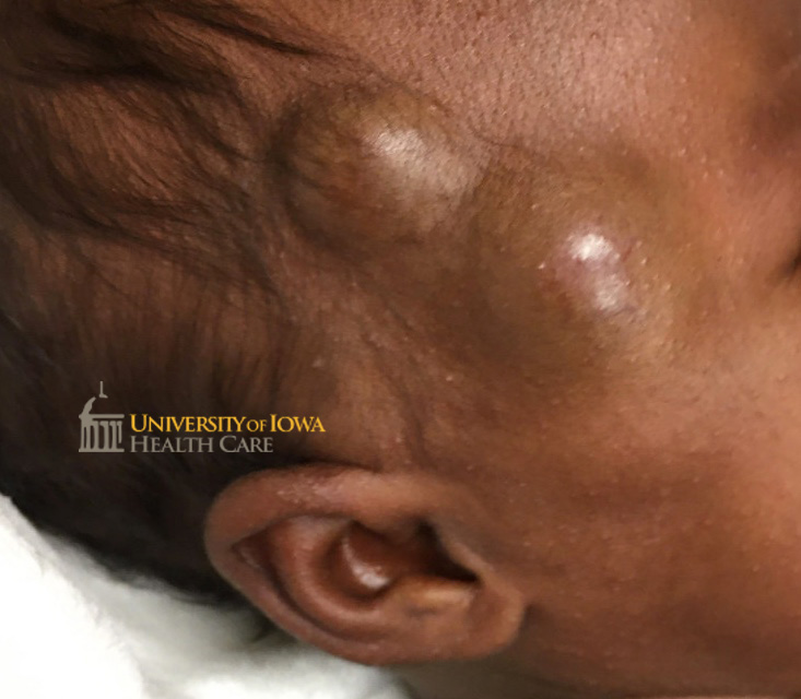 Subcutaneous skin-colored to blue nodules on the right temple. (click images for higher resolution).